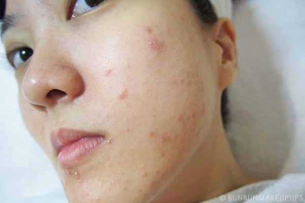 美妝部落客自po做臉慘痛代價4