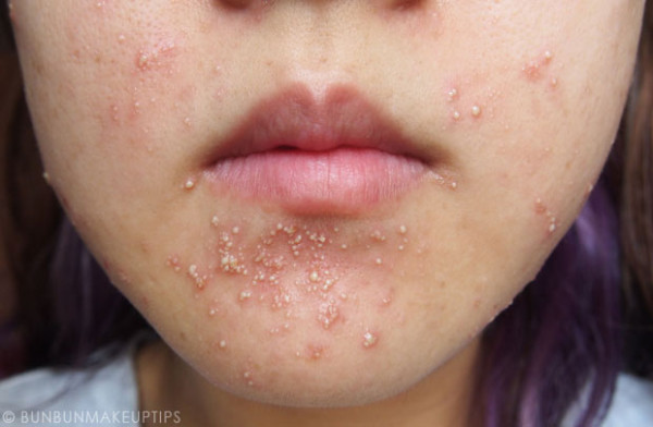 美妝部落客自po做臉慘痛代價5